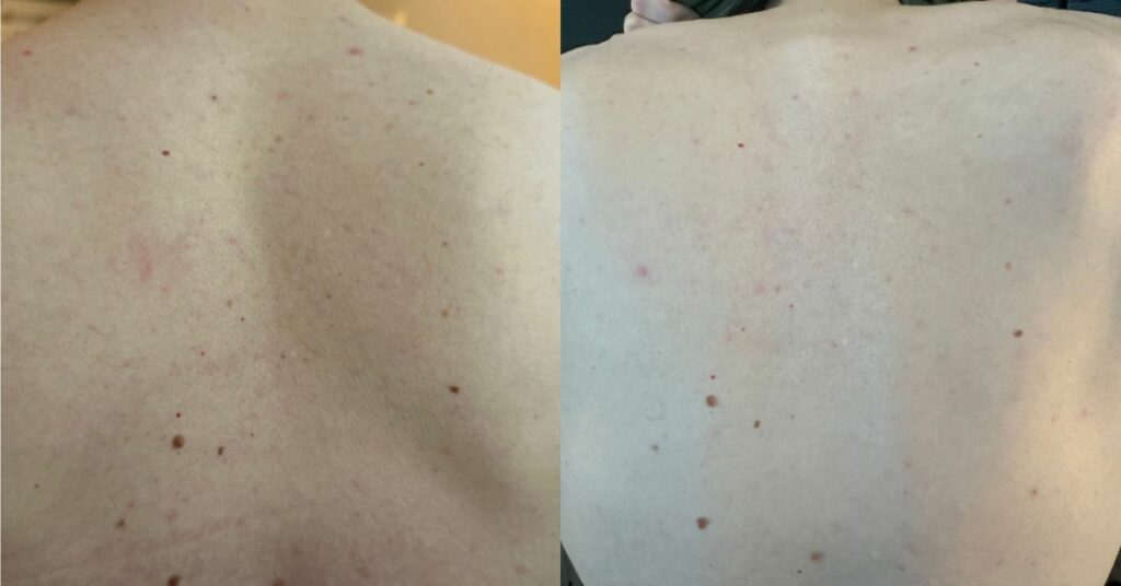 Before and after shot of mans back after using glycolic scrub.